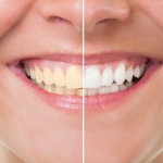 Teeth Whitening