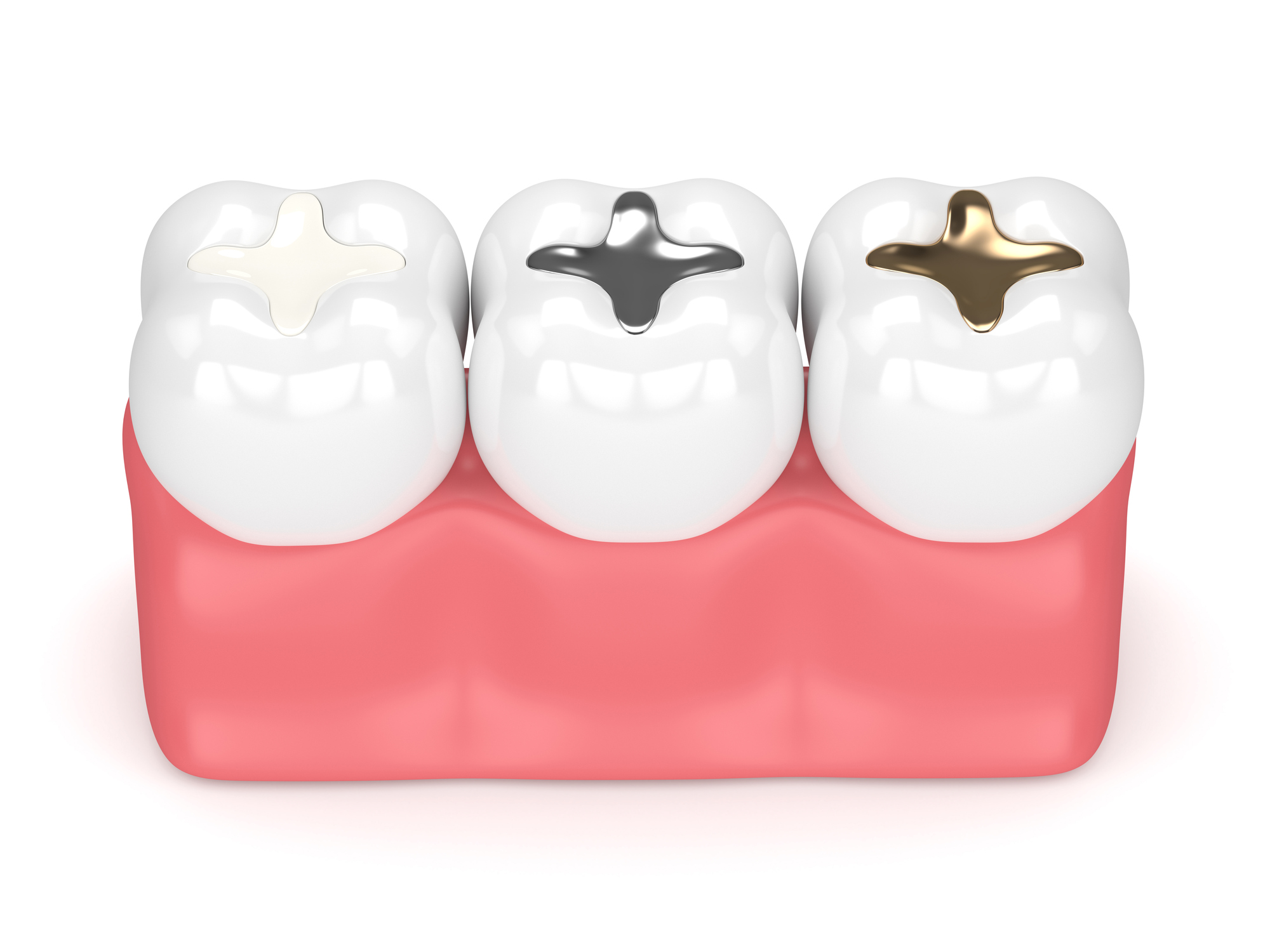 What is the Difference Between Fillings, Inlays, and Onlays? Dentist