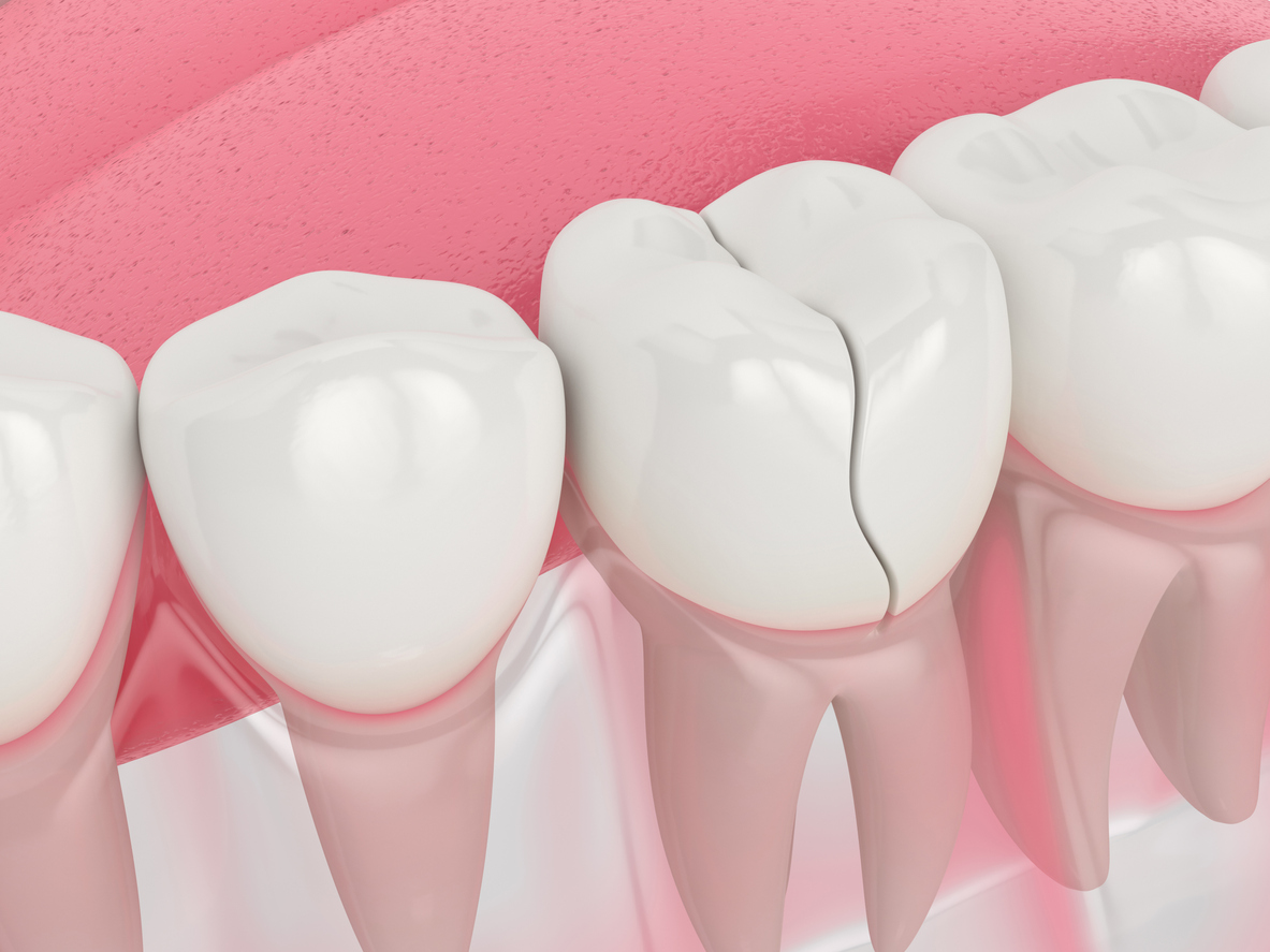 vertical fracture of tooth icd 10