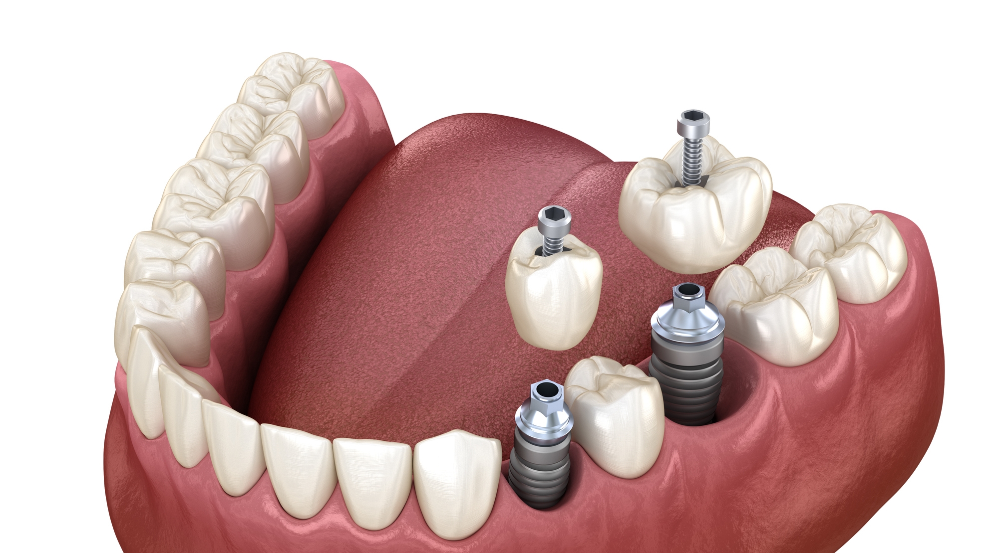 Removable implantbased Dentist in Newbury Park