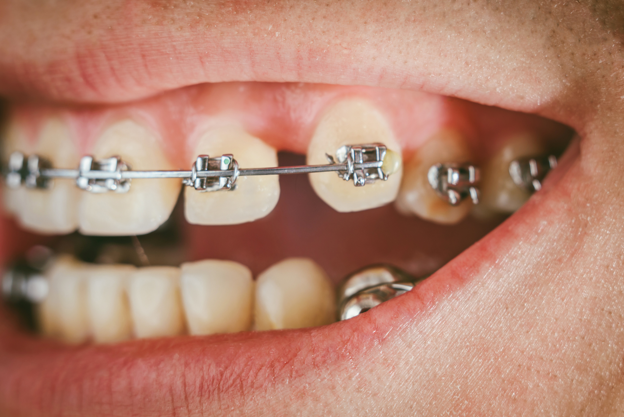 spacing between teeth Dentist in Newbury Park